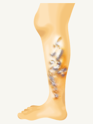 下肢静脈瘤イメージ